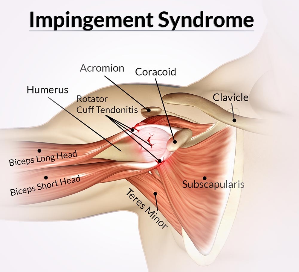 Impingement Syndrome Treatment Bangalore